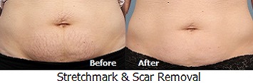Stretch Marks and Scar Removal