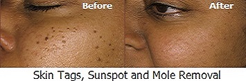 Skin Tags, Sunspots and Mole Removal